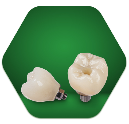 Sứ trên Implant